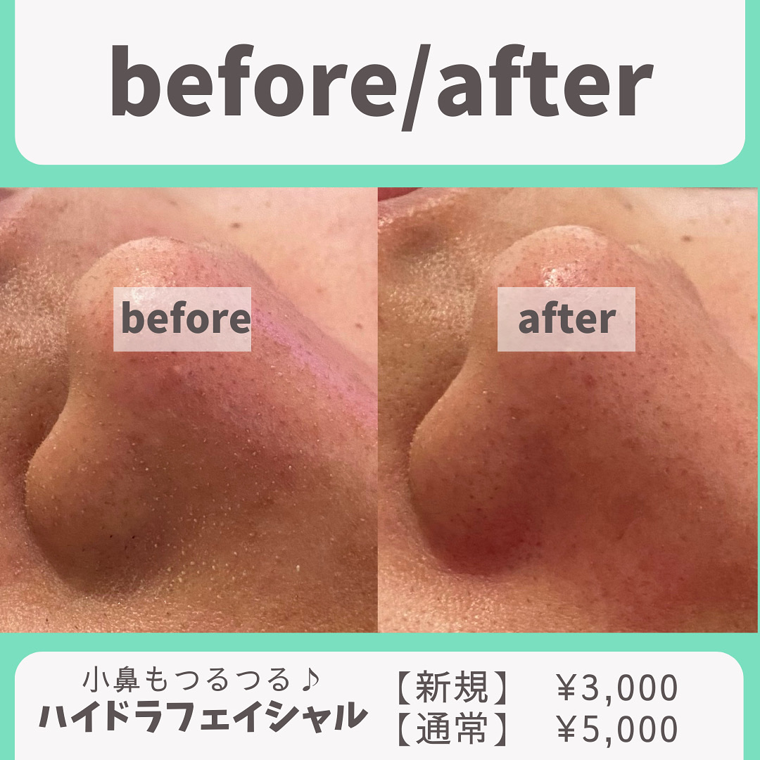 【つるつる】毛穴・頭皮洗浄の効果♪